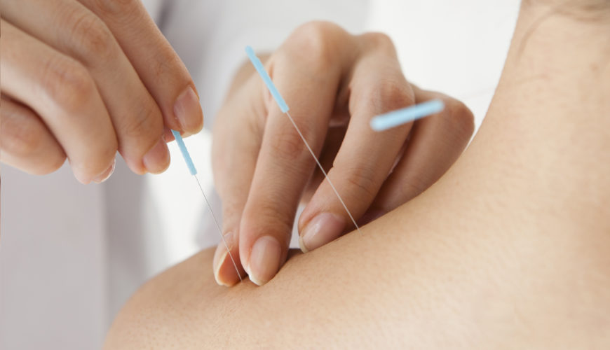 Acupuncture AAIR of Charlotte